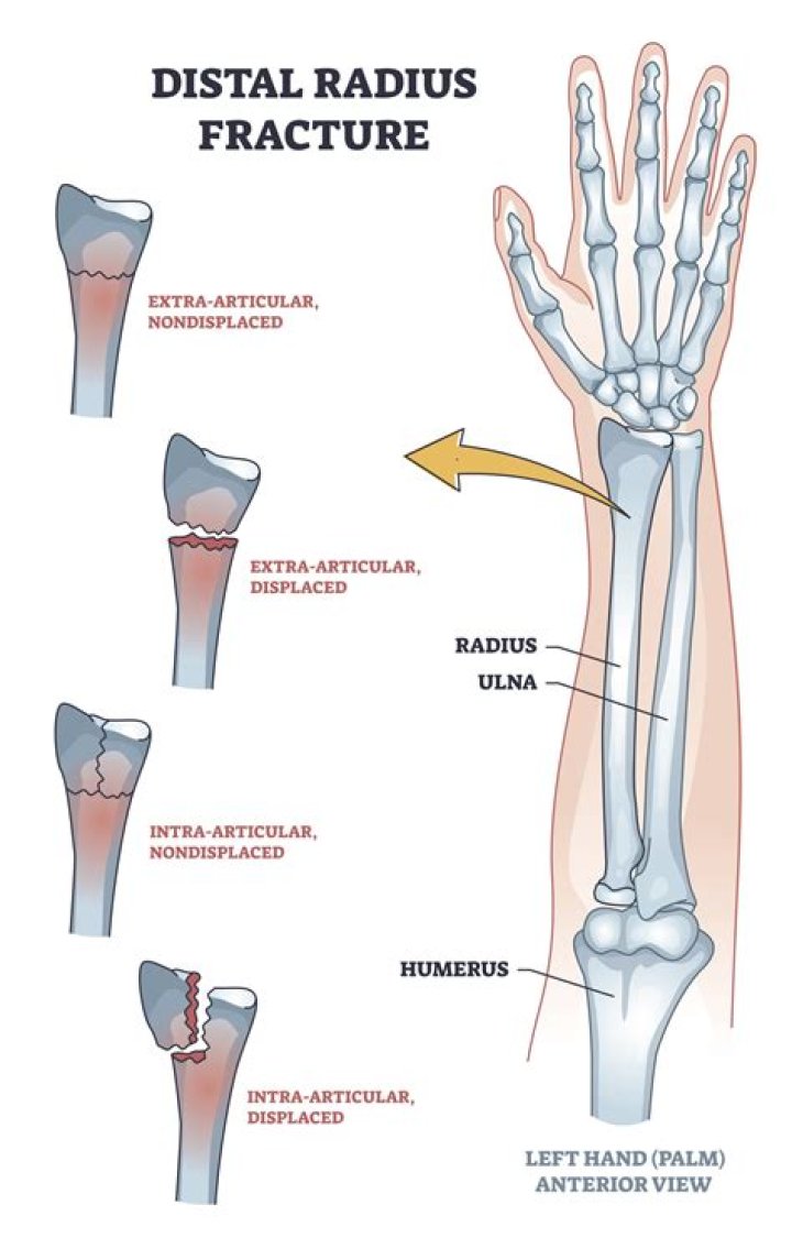 Children's Fractures FAQs | Renown Health